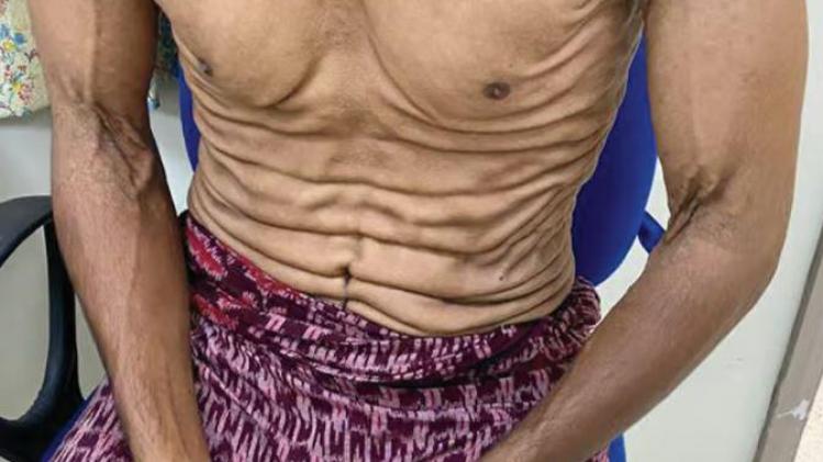 Atteint d’une maladie rare, cet homme a la peau totalement élastique (Photo)